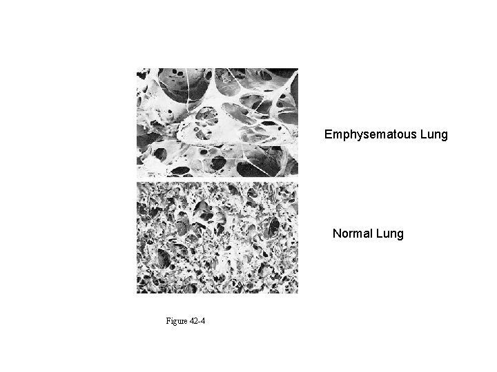 Emphysematous Lung Normal Lung Figure 42 -4 