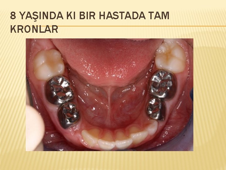 8 YAŞINDA KI BIR HASTADA TAM KRONLAR 