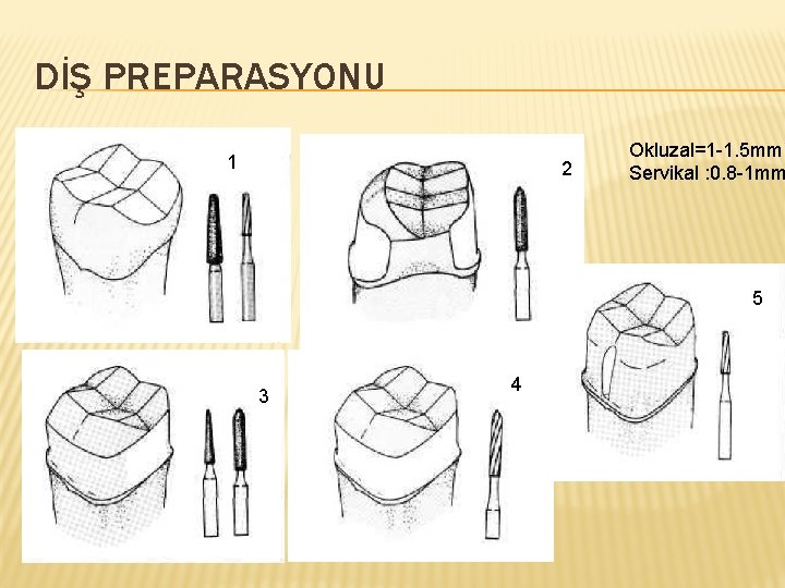 DİŞ PREPARASYONU 1 2 Okluzal=1 -1. 5 mm Servikal : 0. 8 -1 mm