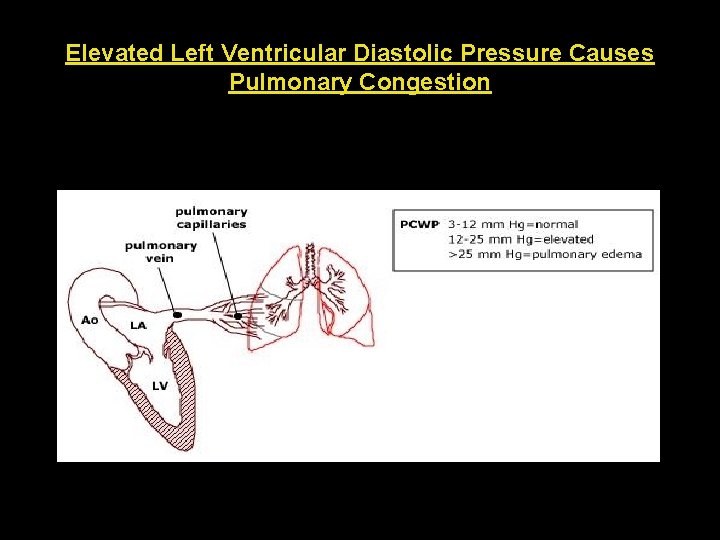 Elevated Left Ventricular Diastolic Pressure Causes Pulmonary Congestion 
