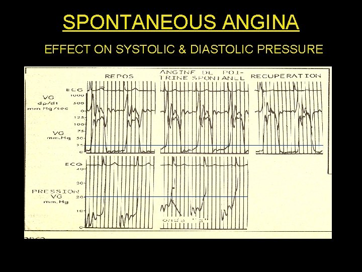 SPONTANEOUS ANGINA EFFECT ON SYSTOLIC & DIASTOLIC PRESSURE 