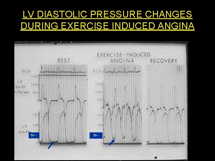 LV DIASTOLIC PRESSURE CHANGES DURING EXERCISE INDUCED ANGINA 50 --- 