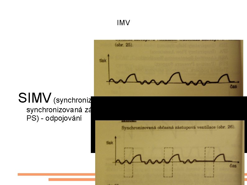 IMV SIMV (synchronized intermittent ventilation) – synchronizovaná zástupná ventilace; (dnes v praxi SIMV+ PS)