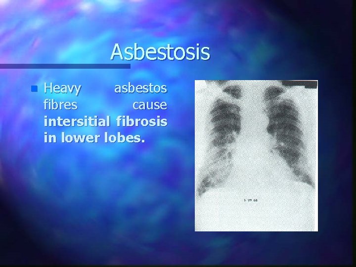 Asbestosis n Heavy asbestos fibres cause intersitial fibrosis in lower lobes. 