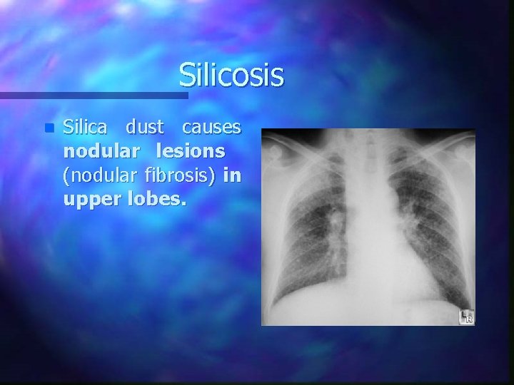 Silicosis n Silica dust causes nodular lesions (nodular fibrosis) in upper lobes. 