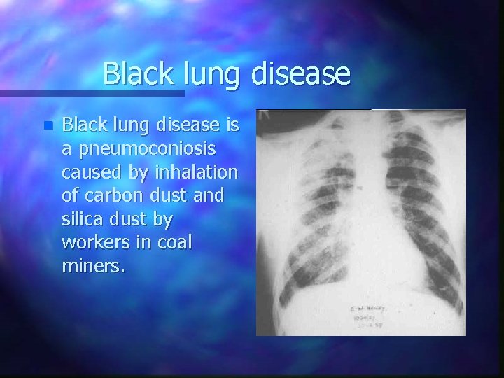 Black lung disease n Black lung disease is a pneumoconiosis caused by inhalation of