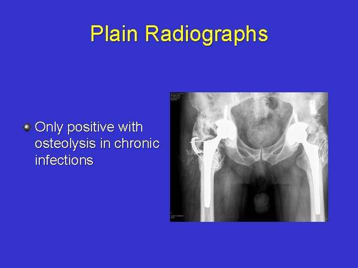 Plain Radiographs Only positive with osteolysis in chronic infections 