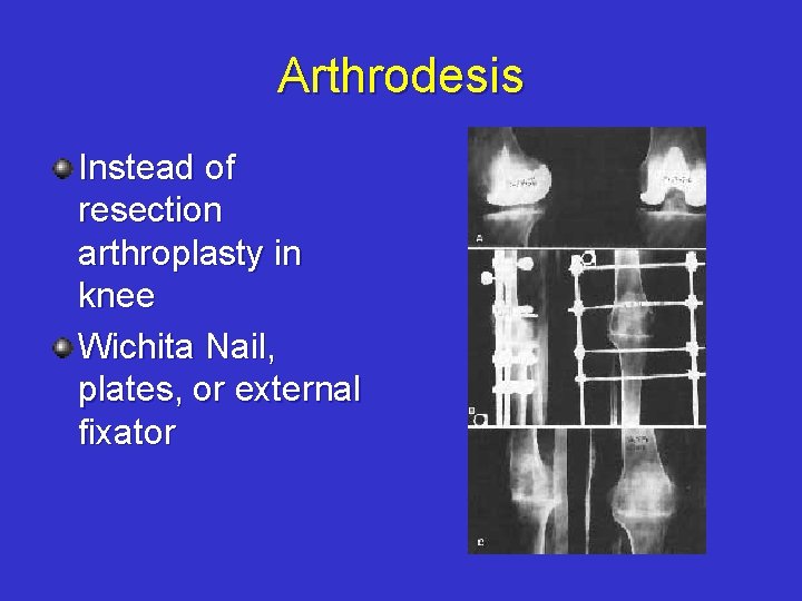 Arthrodesis Instead of resection arthroplasty in knee Wichita Nail, plates, or external fixator 