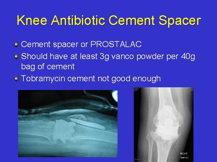 Knee Antibiotic Cement Spacer Cement spacer or PROSTALAC Should have at least 3 g