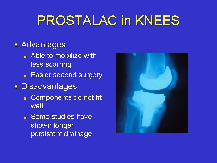 PROSTALAC in KNEES Advantages n n Able to mobilize with less scarring Easier second