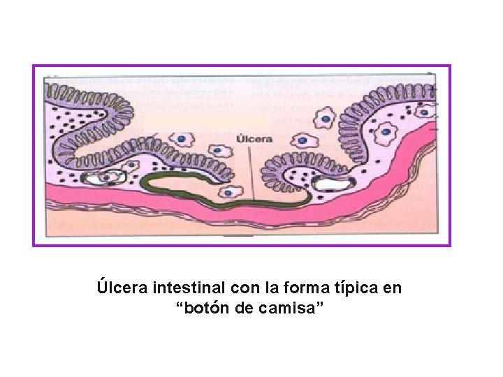 Úlcera intestinal con la forma típica en “botón de camisa” 