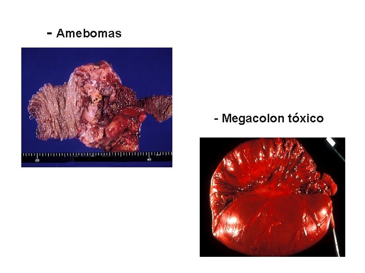 - Amebomas - Megacolon tóxico 