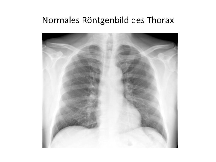 Normales Röntgenbild des Thorax 