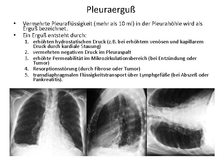 Pleuraerguß • • Vermehrte Pleuraflüssigkeit (mehr als 10 ml) in der Pleurahöhle wird als