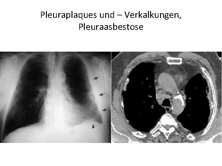 Pleuraplaques und – Verkalkungen, Pleuraasbestose 