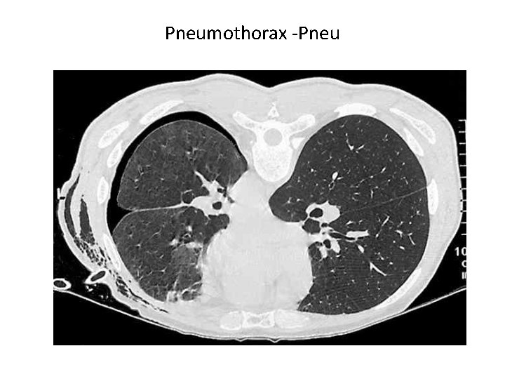 Pneumothorax -Pneu 