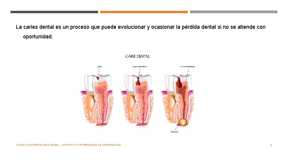 La caries dental es un proceso que puede evolucionar y ocasionar la pérdida dental