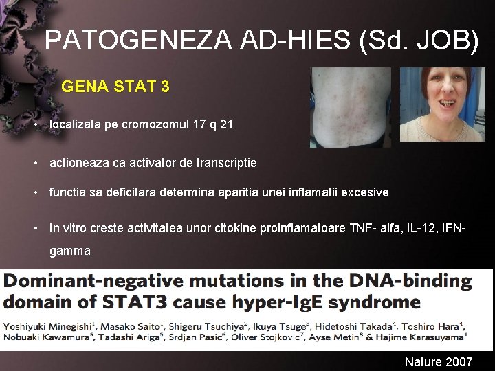 PATOGENEZA AD HIES (Sd. JOB) GENA STAT 3 • localizata pe cromozomul 17 q