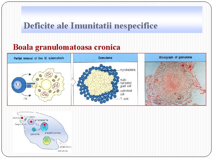 Deficite ale Imunitatii nespecifice Boala granulomatoasa cronica 