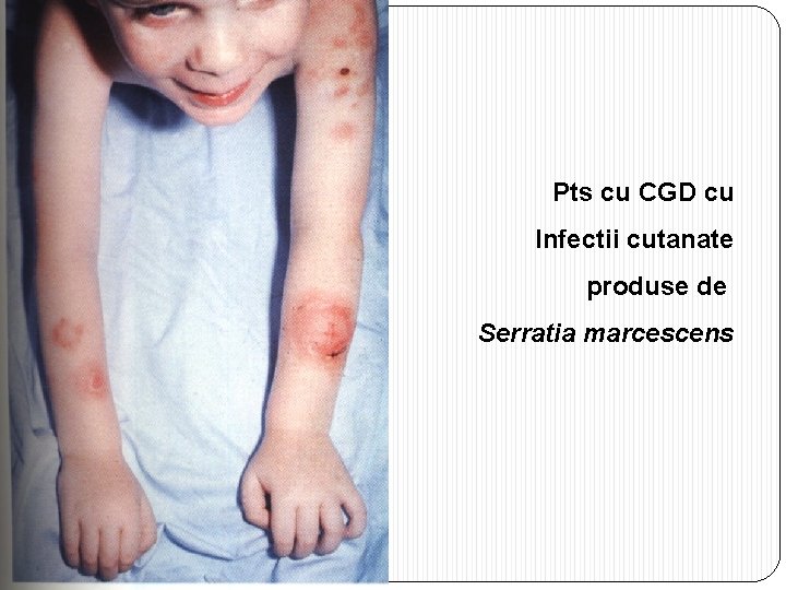 Pts cu CGD cu Infectii cutanate produse de Serratia marcescens 