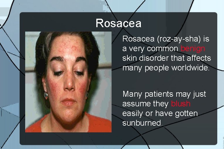 Rosacea (roz-ay-sha) is a very common benign skin disorder that affects many people worldwide.