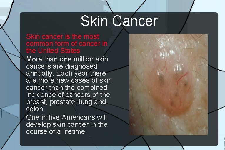 Skin Cancer Skin cancer is the most common form of cancer in the United