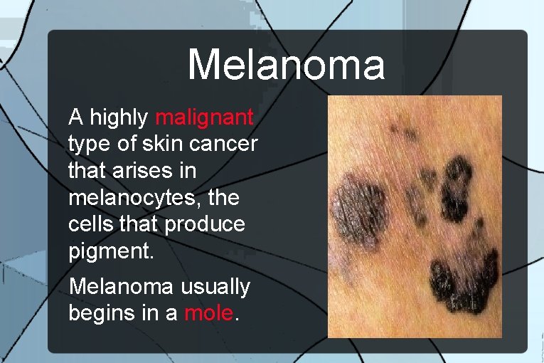 Melanoma A highly malignant type of skin cancer that arises in melanocytes, the cells