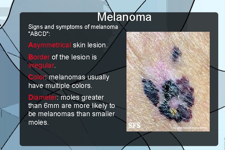 Melanoma Signs and symptoms of melanoma "ABCD": Asymmetrical skin lesion. Border of the lesion