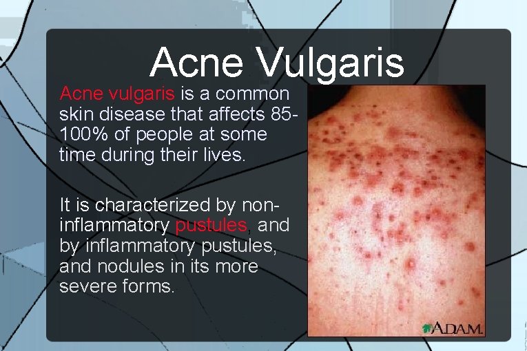 Acne Vulgaris Acne vulgaris is a common skin disease that affects 85100% of people