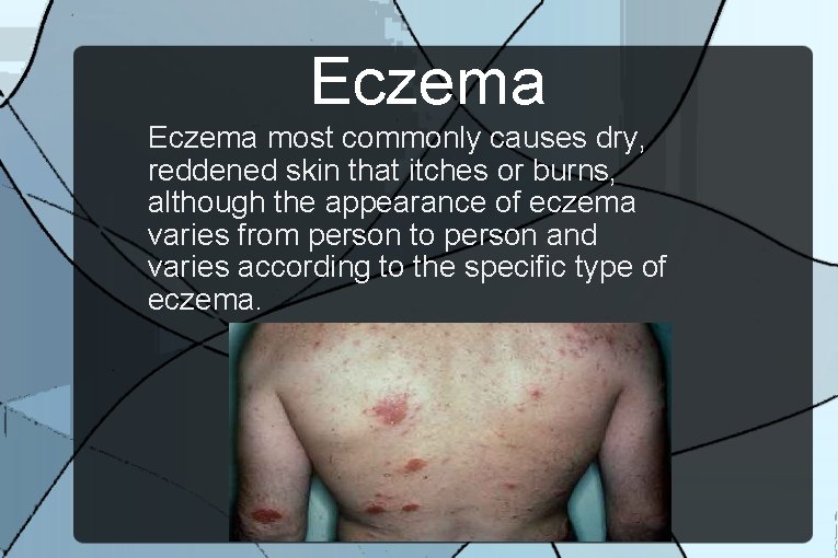 Eczema most commonly causes dry, reddened skin that itches or burns, although the appearance