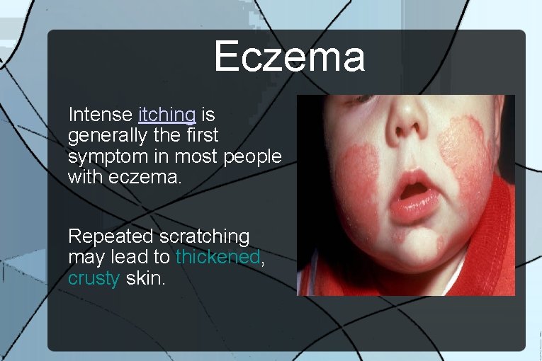 Eczema Intense itching is generally the first symptom in most people with eczema. Repeated