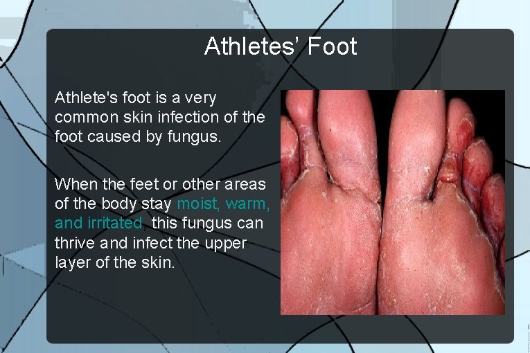 Athletes’ Foot Athlete's foot is a very common skin infection of the foot caused