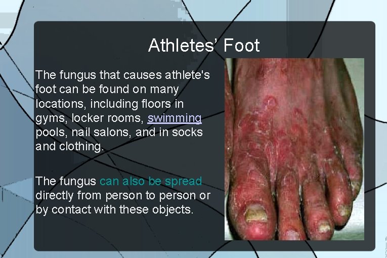 Athletes’ Foot The fungus that causes athlete's foot can be found on many locations,
