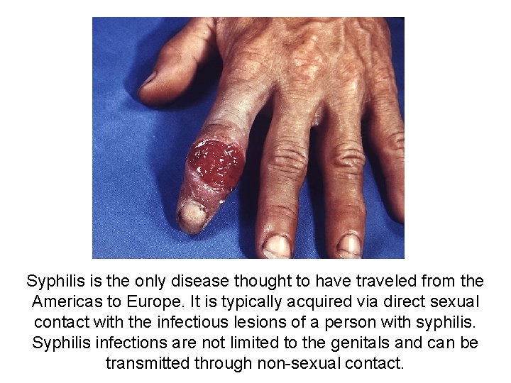 Syphilis is the only disease thought to have traveled from the Americas to Europe.