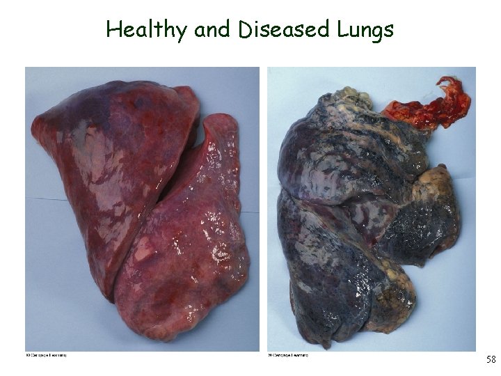 Healthy and Diseased Lungs 58 
