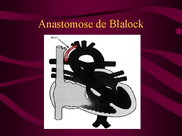 Anastomose de Blalock 