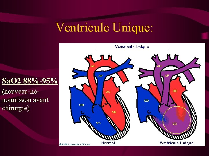 Ventricule Unique: Sa. O 2 88%-95% (nouveau-nénourrisson avant chirurgie) 