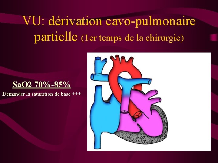 VU: dérivation cavo-pulmonaire partielle (1 er temps de la chirurgie) Sa. O 2 70%-85%