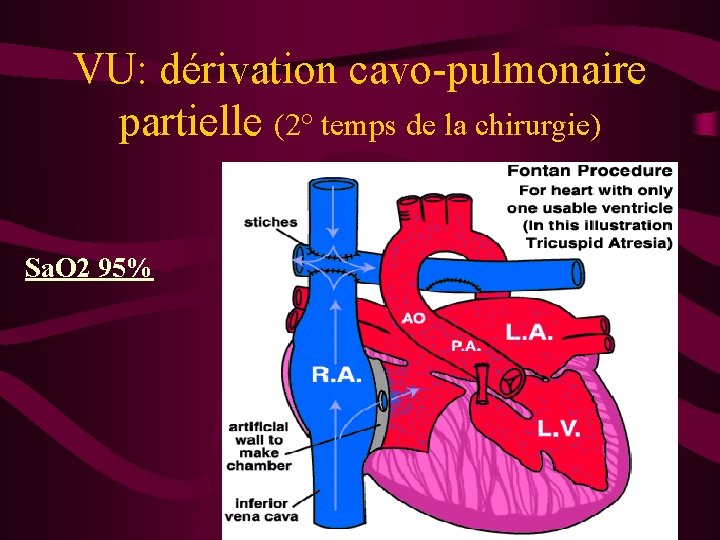 VU: dérivation cavo-pulmonaire partielle (2° temps de la chirurgie) Sa. O 2 95% 