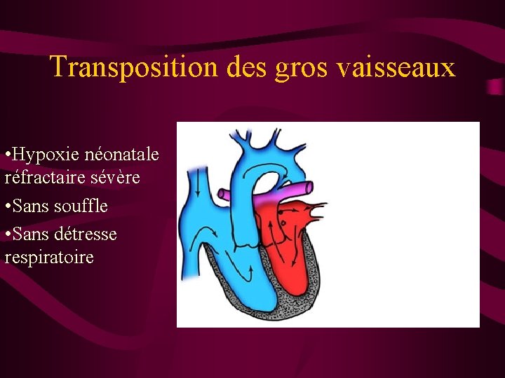 Transposition des gros vaisseaux • Hypoxie néonatale réfractaire sévère • Sans souffle • Sans