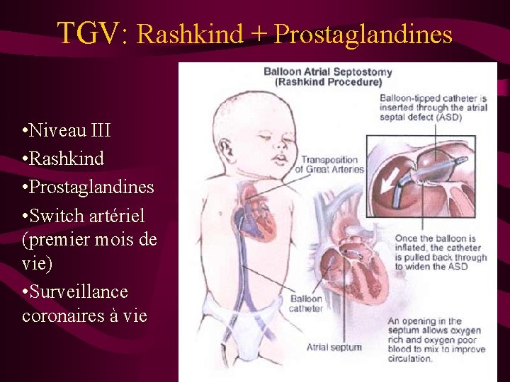 TGV: Rashkind + Prostaglandines • Niveau III • Rashkind • Prostaglandines • Switch artériel