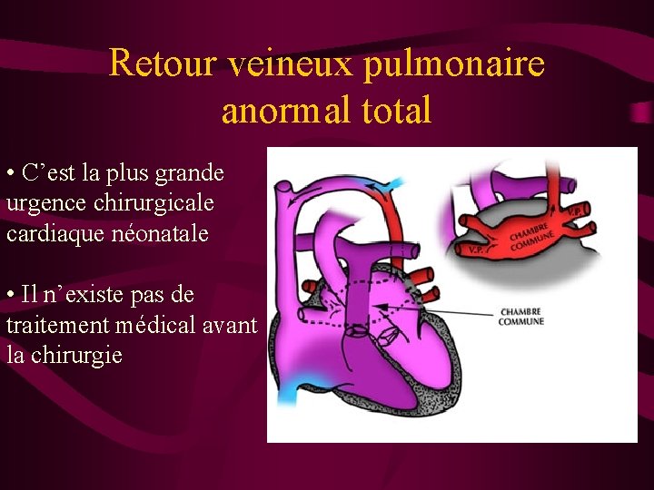 Retour veineux pulmonaire anormal total • C’est la plus grande urgence chirurgicale cardiaque néonatale