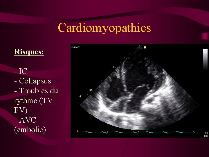 Cardiomyopathies Risques: - IC - Collapsus - Troubles du rythme (TV, FV) - AVC