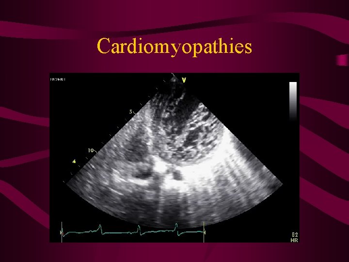 Cardiomyopathies 