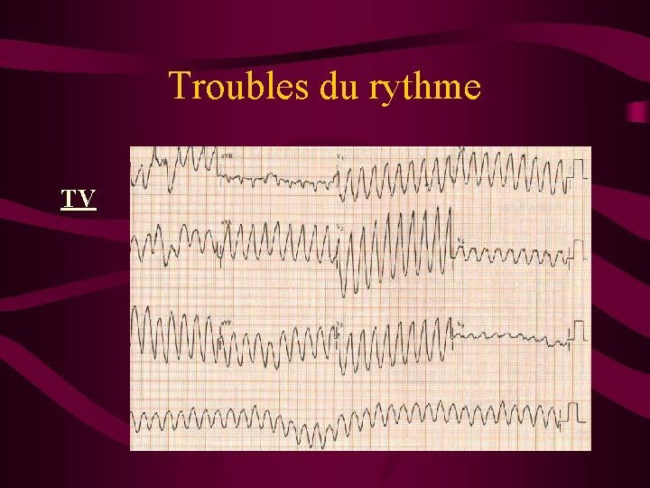 Troubles du rythme TV 