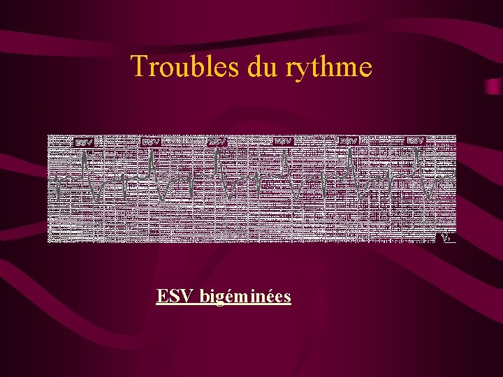 Troubles du rythme ESV bigéminées 