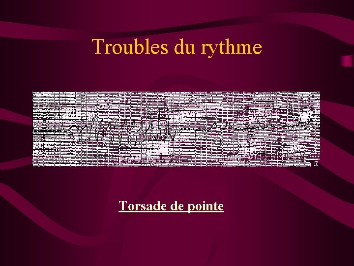 Troubles du rythme Torsade de pointe 