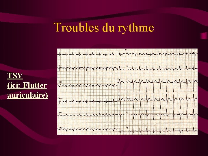 Troubles du rythme TSV (ici: Flutter auriculaire) 