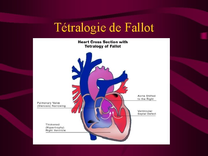 Tétralogie de Fallot 