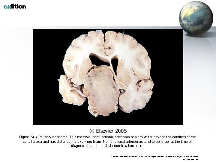 Figure 24 -4 Pituitary adenoma. This massive, nonfunctional adenoma has grown far beyond the